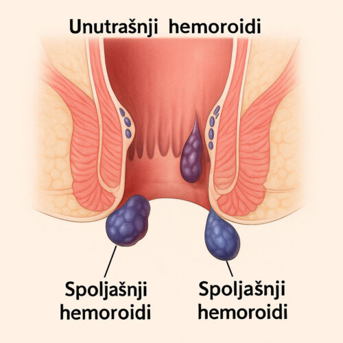 Ilustracija unutrašnjih i spoljašnjih hemoroida